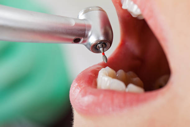 Best Emergency Dental Care for Abscessed Tooth in Marysville, CA